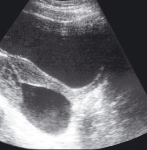 гипоэхогенное образование в шейке матки на узи. серозоцеле в гинекологии что это. образования малого таза по узи. расширение вен малого таза узи. серозоцеле в гинекологии.